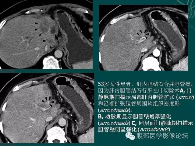 【PPT】胆管癌的CT诊断