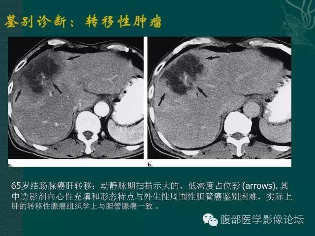 【PPT】胆管癌的CT诊断