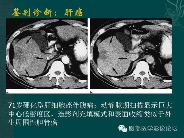 【PPT】胆管癌的CT诊断