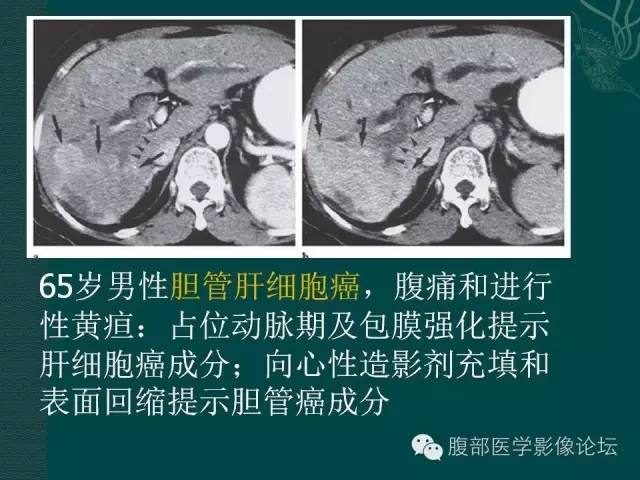 【PPT】胆管癌的CT诊断