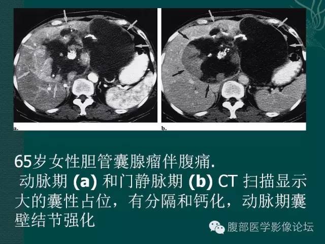 【PPT】胆管癌的CT诊断