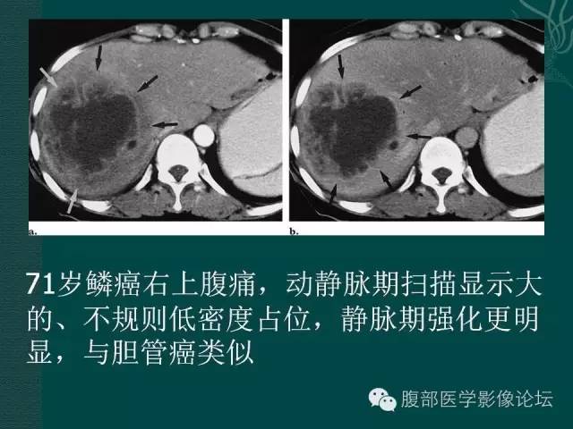 【PPT】胆管癌的CT诊断