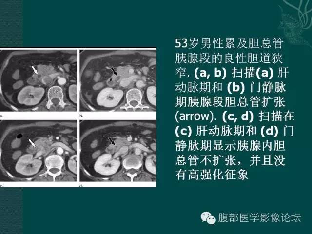 【PPT】胆管癌的CT诊断