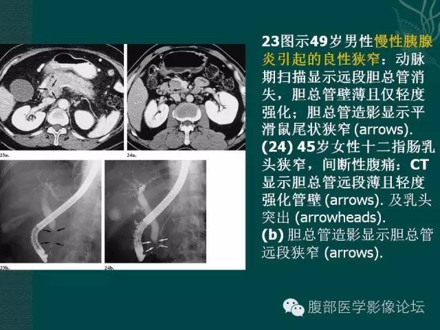 【PPT】胆管癌的CT诊断