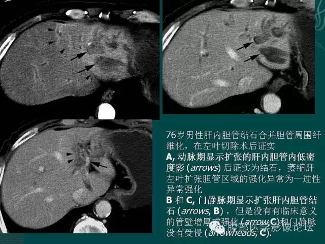 【PPT】胆管癌的CT诊断