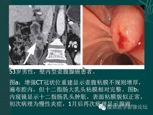 【PPT】胆管癌的CT诊断