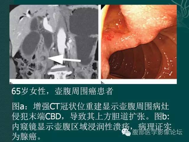 【PPT】胆管癌的CT诊断
