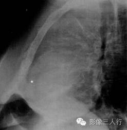 "脂肪垫征"，这个征象提示啥？