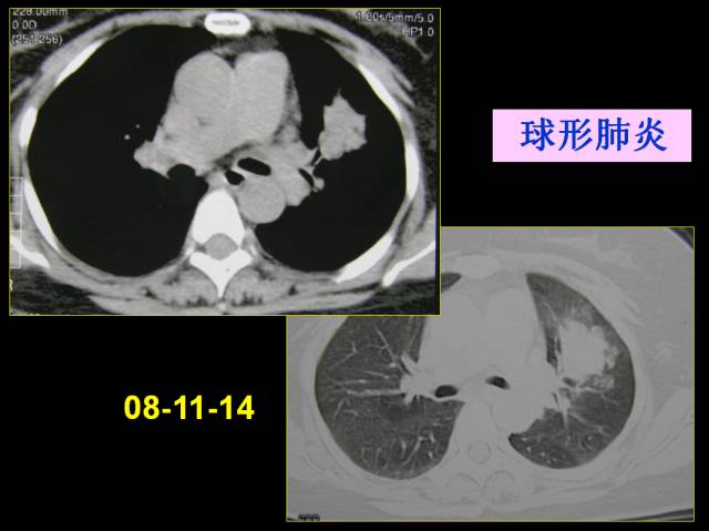 这些也是肺部常见病的基本征象,你都知道么? 这些也是肺部常见病的基本征象,你都知道么?