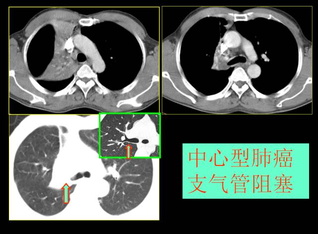 这些也是肺部常见病的基本征象,你都知道么? 这些也是肺部常见病的基本征象,你都知道么?