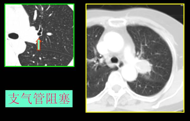 这些也是肺部常见病的基本征象,你都知道么? 这些也是肺部常见病的基本征象,你都知道么?