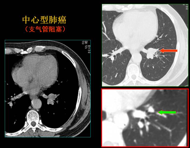 这些也是肺部常见病的基本征象,你都知道么? 这些也是肺部常见病的基本征象,你都知道么?
