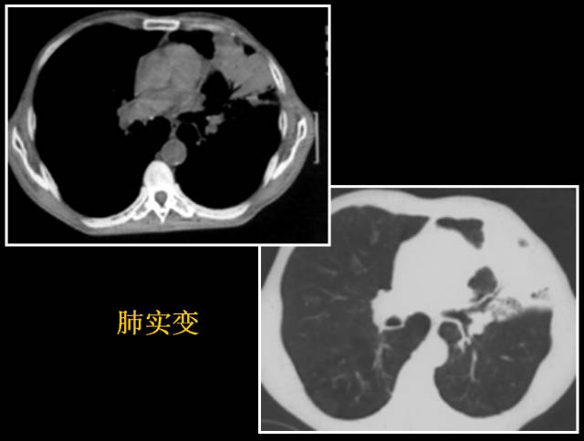 这些也是肺部常见病的基本征象,你都知道么? 这些也是肺部常见病的基本征象,你都知道么?