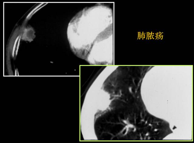 这些也是肺部常见病的基本征象,你都知道么? 这些也是肺部常见病的基本征象,你都知道么?