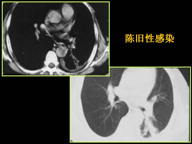 这些也是肺部常见病的基本征象,你都知道么? 这些也是肺部常见病的基本征象,你都知道么?