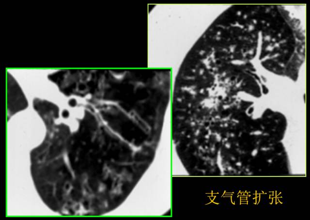 这些也是肺部常见病的基本征象,你都知道么? 这些也是肺部常见病的基本征象,你都知道么?