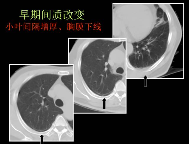这些也是肺部常见病的基本征象,你都知道么? 这些也是肺部常见病的基本征象,你都知道么?