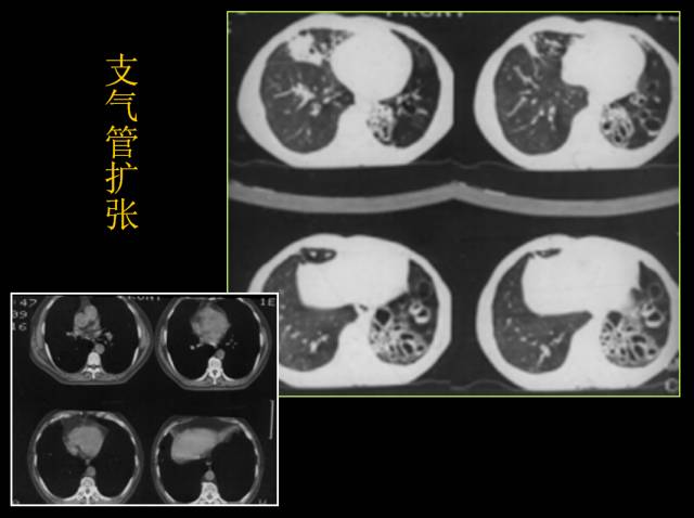 这些也是肺部常见病的基本征象,你都知道么? 这些也是肺部常见病的基本征象,你都知道么?