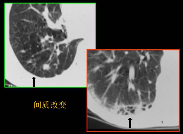 这些也是肺部常见病的基本征象,你都知道么? 这些也是肺部常见病的基本征象,你都知道么?