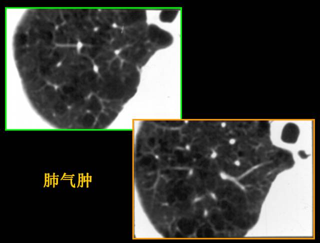 这些也是肺部常见病的基本征象,你都知道么? 这些也是肺部常见病的基本征象,你都知道么?