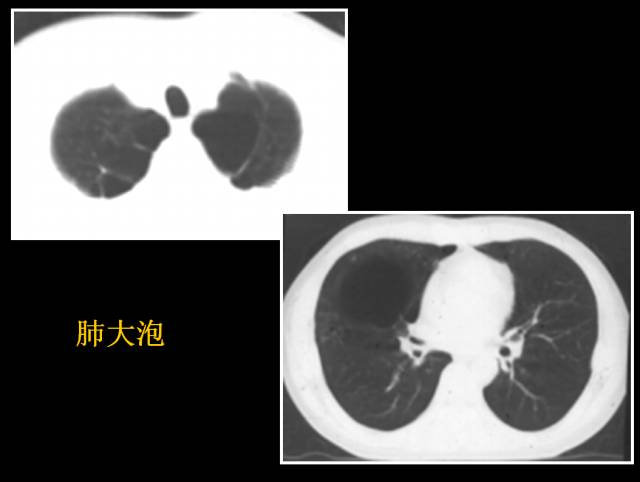 这些也是肺部常见病的基本征象,你都知道么? 这些也是肺部常见病的基本征象,你都知道么?