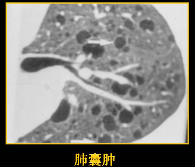 这些也是肺部常见病的基本征象,你都知道么? 这些也是肺部常见病的基本征象,你都知道么?