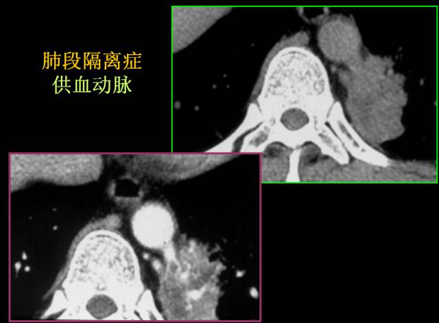 这些也是肺部常见病的基本征象,你都知道么? 这些也是肺部常见病的基本征象,你都知道么?