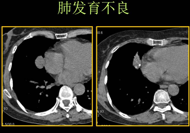 这些也是肺部常见病的基本征象,你都知道么? 这些也是肺部常见病的基本征象,你都知道么?