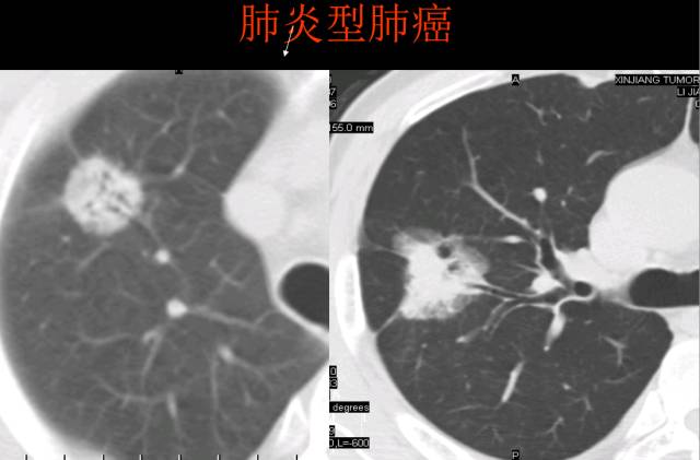 这些也是肺部常见病的基本征象,你都知道么? 这些也是肺部常见病的基本征象,你都知道么?