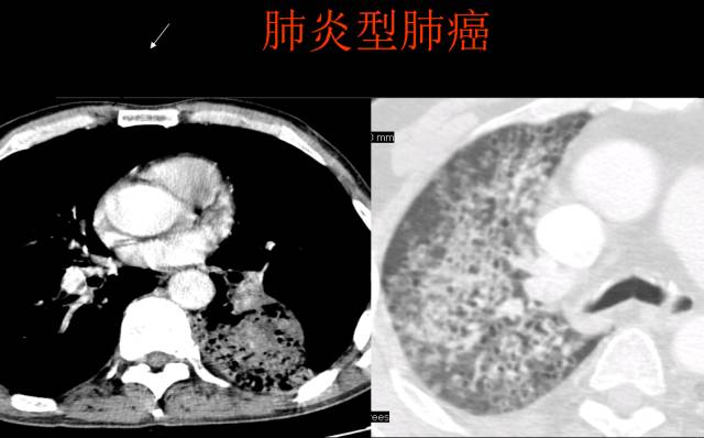这些也是肺部常见病的基本征象,你都知道么? 这些也是肺部常见病的基本征象,你都知道么?
