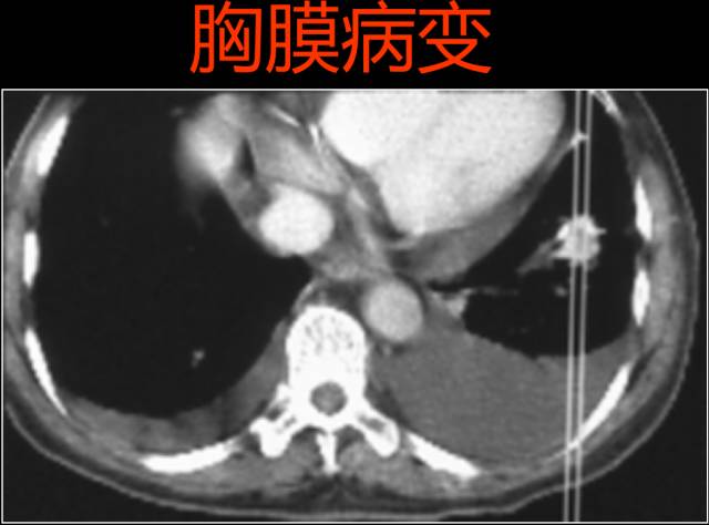 这些也是肺部常见病的基本征象,你都知道么? 这些也是肺部常见病的基本征象,你都知道么?