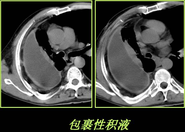 这些也是肺部常见病的基本征象,你都知道么? 这些也是肺部常见病的基本征象,你都知道么?