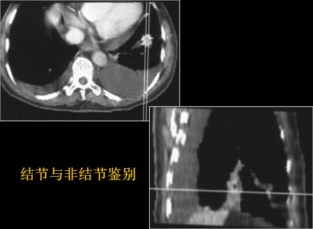 这些也是肺部常见病的基本征象,你都知道么? 这些也是肺部常见病的基本征象,你都知道么?