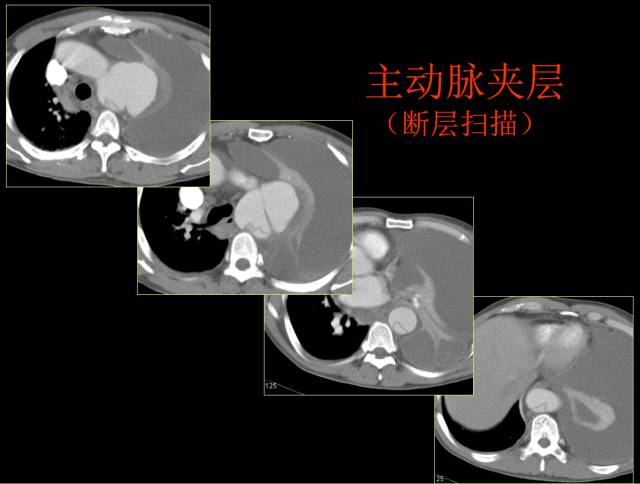 这些也是肺部常见病的基本征象,你都知道么? 这些也是肺部常见病的基本征象,你都知道么?