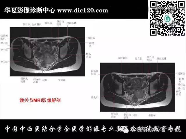 【PPT】髋关节常见疾病影像学诊断
