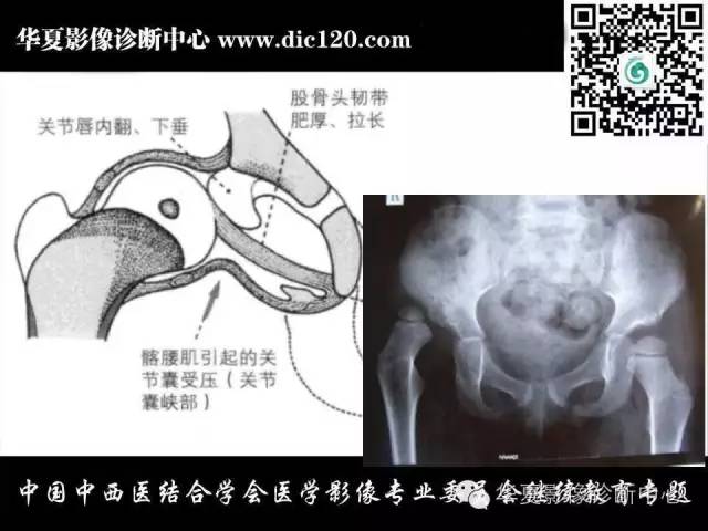 【PPT】髋关节常见疾病影像学诊断