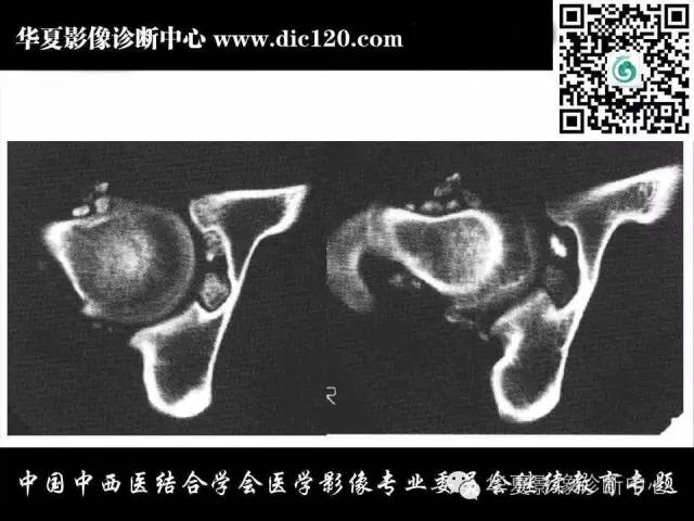 【PPT】髋关节常见疾病影像学诊断