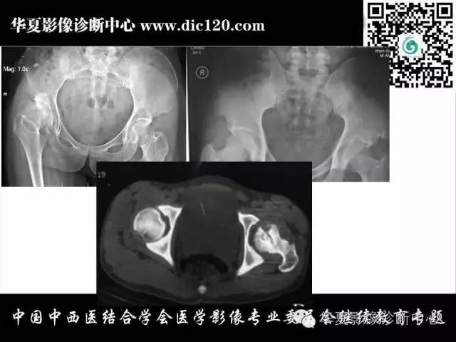【PPT】髋关节常见疾病影像学诊断