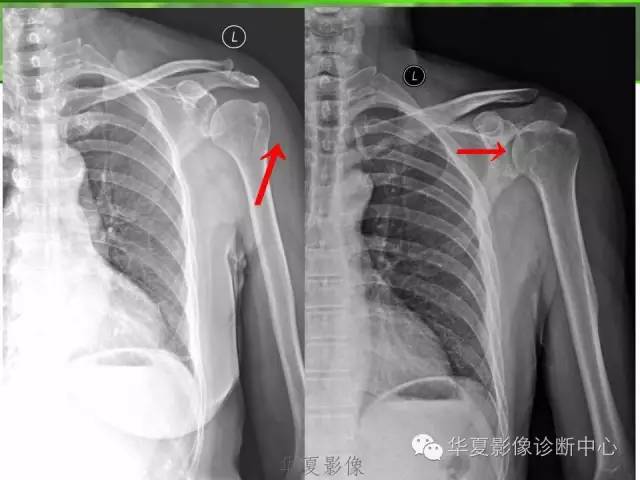 X线片怎么看肩周炎