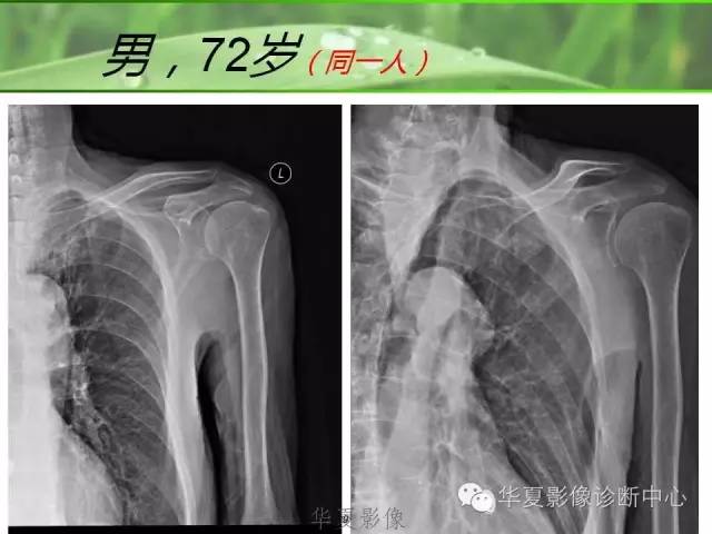X线片怎么看肩周炎 X线片怎么看肩周炎