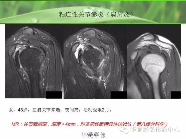 X线片怎么看肩周炎 X线片怎么看肩周炎