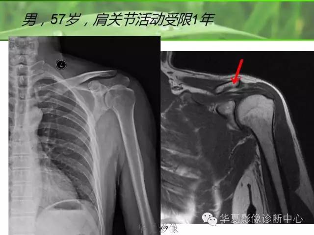 X线片怎么看肩周炎 X线片怎么看肩周炎