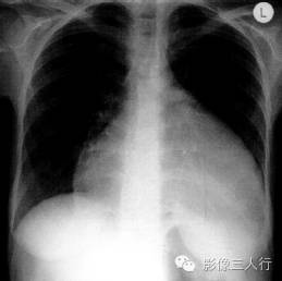 "烧瓶心"，这个征象提示啥？
