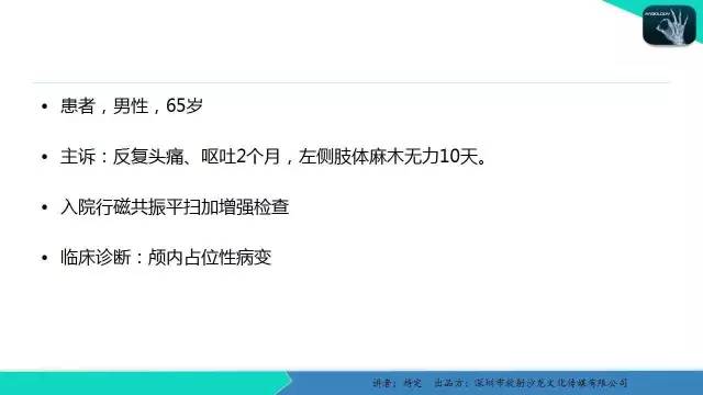 【病例】胶质母细胞瘤1例MR影像表现