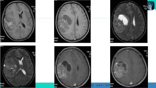 【病例】胶质母细胞瘤1例MR影像表现
