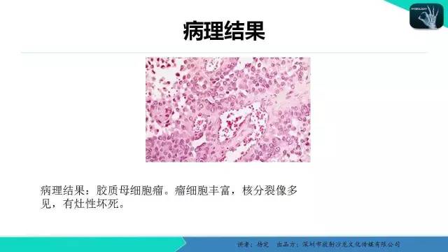 【病例】胶质母细胞瘤1例MR影像表现