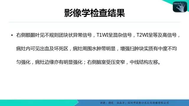 【病例】胶质母细胞瘤1例MR影像表现