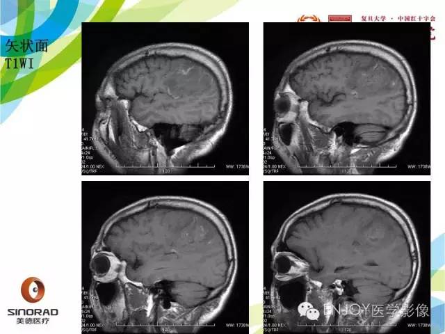【病例】原发性中枢神经系统血管炎1例MR影像表现