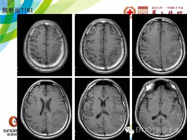 【病例】原发性中枢神经系统血管炎1例MR影像表现