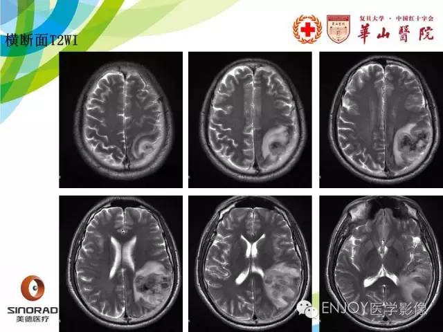 【病例】原发性中枢神经系统血管炎1例MR影像表现